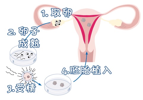 关于 专业同性供卵助孕收费标准